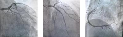 Extracorporeal cardiopulmonary resuscitation successfully used in a two-hour cardiac arrest caused by fulminant myocarditis: a case report